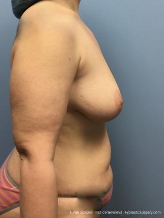 Mommy Makeover: Patient 13 - Before Image 3