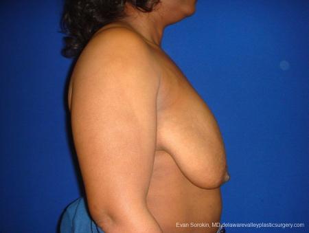 Philadelphia Breast Lift and Augmentation 8684 - Before and After Image 4