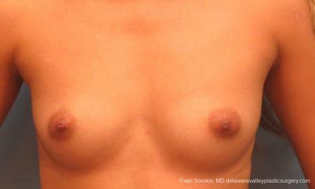 Philadelphia Breast Augmentation 9341 - Before Image 1