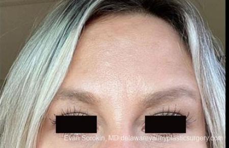BOTOX® Cosmetic: Patient 4 - After Image 1