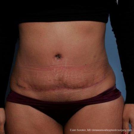 Philadelphia Abdominoplasty 9479 - After Image 1
