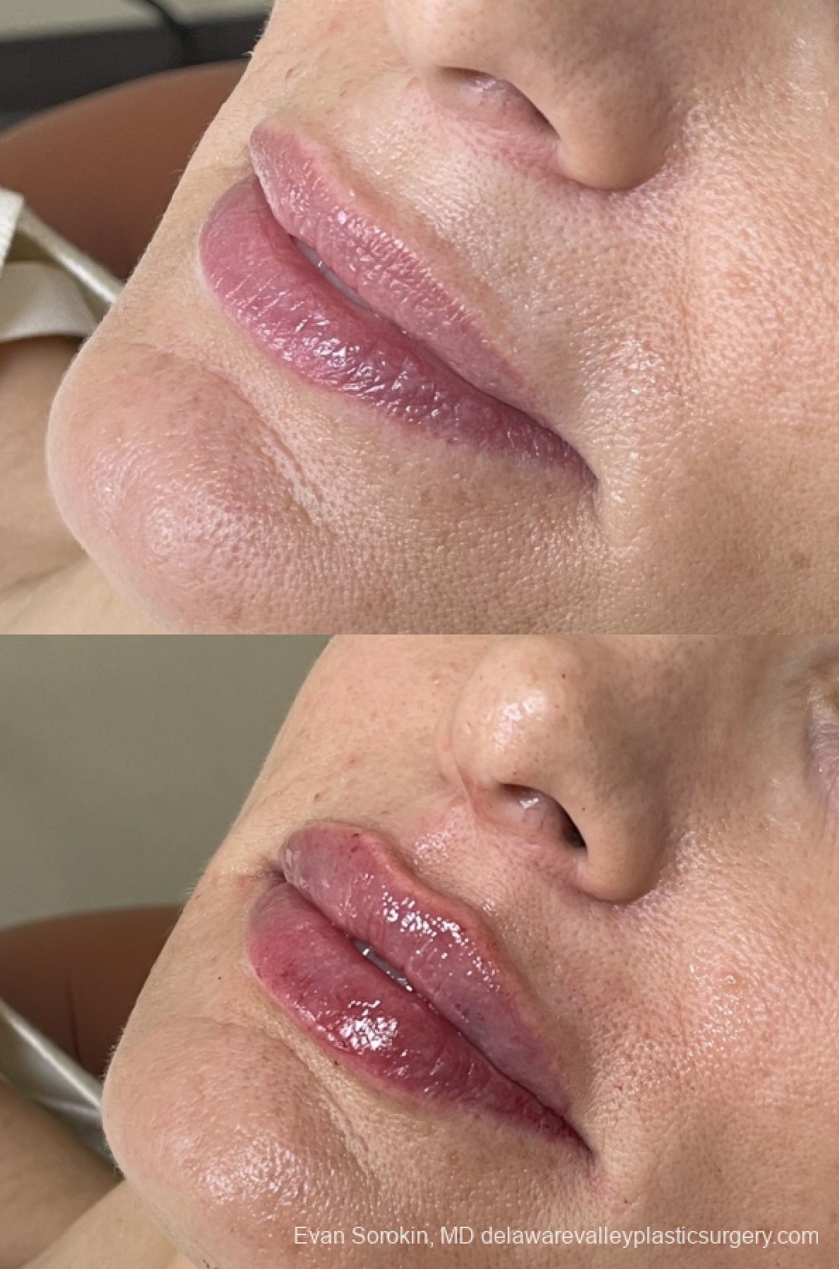 Lip Augmentation: Patient 60 - Before and After 3