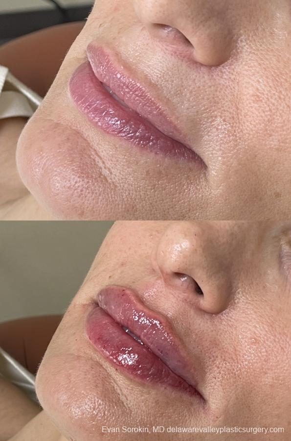 Lip Augmentation: Patient 62 - Before and After 3