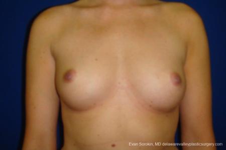 Philadelphia Breast Augmentation 8670 - Before Image 1