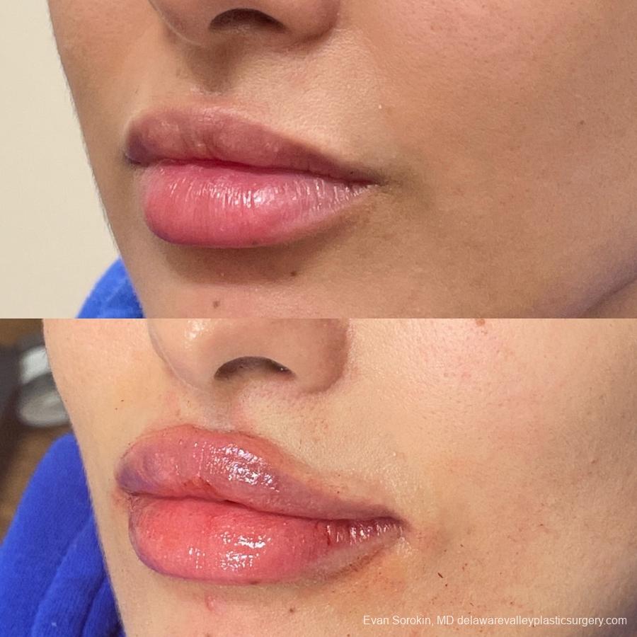 Lip Filler: Patient 1 - Before and After 3