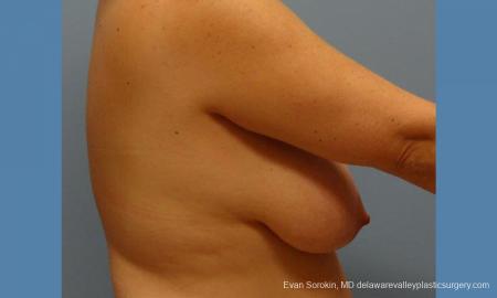 Philadelphia Breast Reduction 9430 - Before and After Image 4