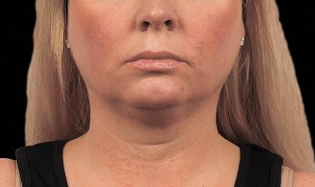 CoolSculpting®: Patient 5 - Before and After Image 2