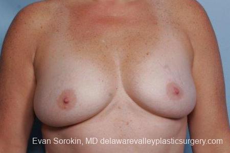Philadelphia Breast Augmentation 9316 - Before Image 1