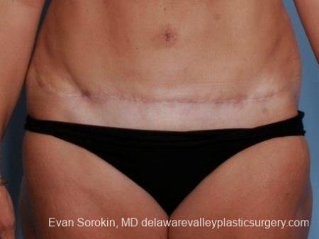 Philadelphia Abdominoplasty 8682 - After Image 1