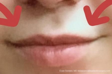 Lip Filler: Patient 19 - Before Image 1