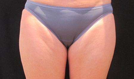 CoolSculpting®: Patient 9 - Before Image 1