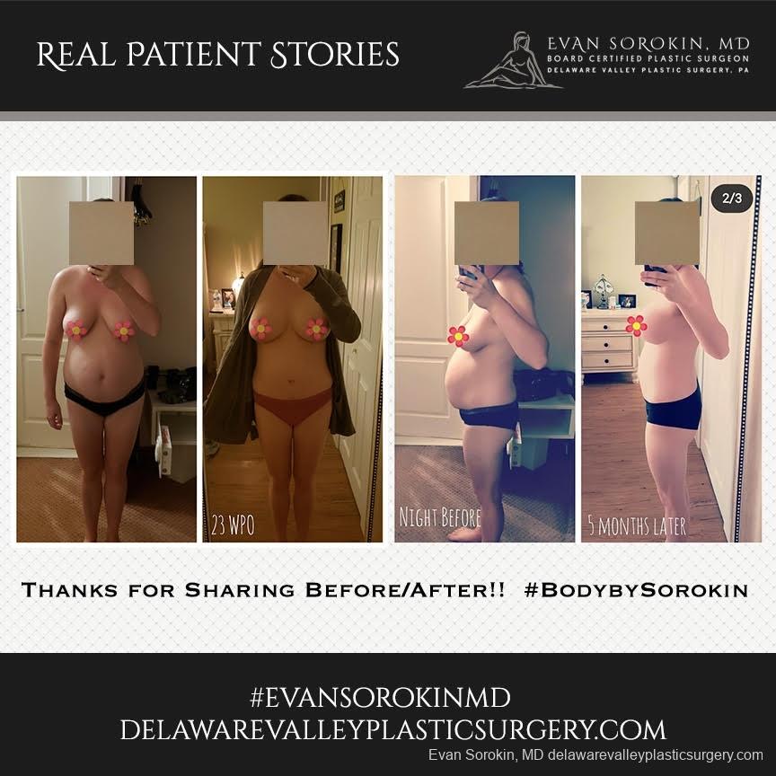 Real Patient Stories: Patient 20 - Before and After Image 1