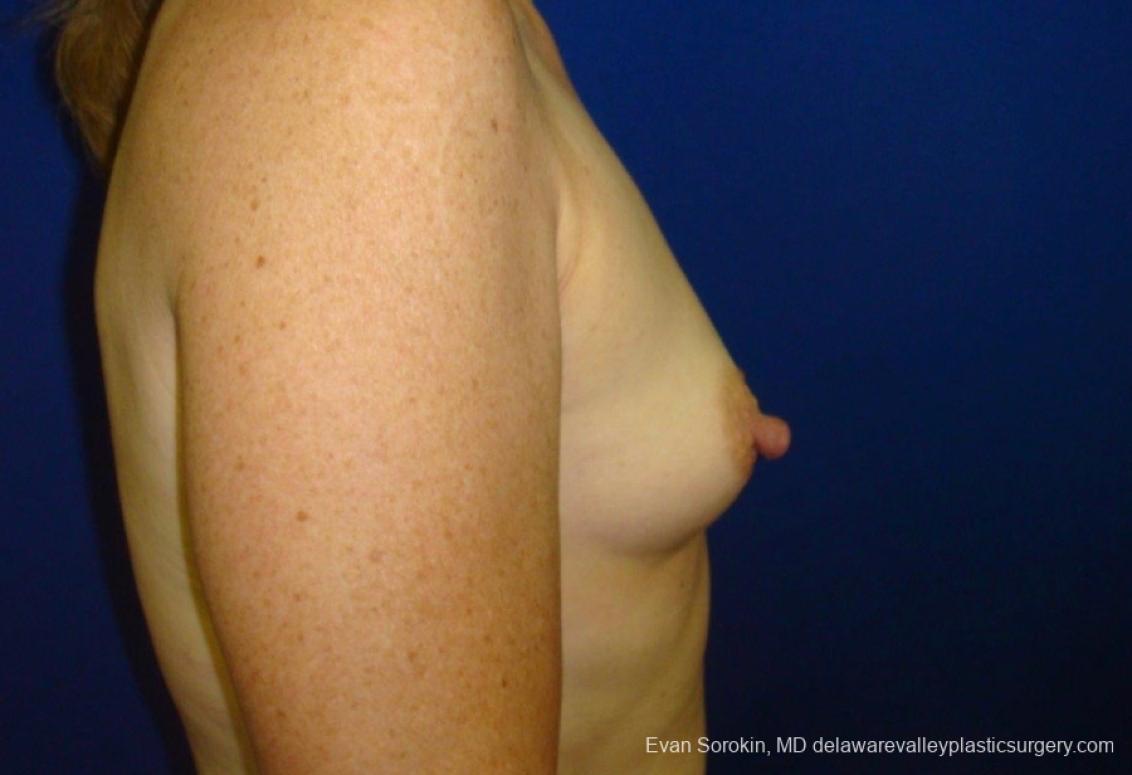 Philadelphia Breast Augmentation 8765 - Before 4