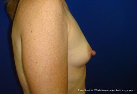 Philadelphia Breast Augmentation 8765 - Before Image 4