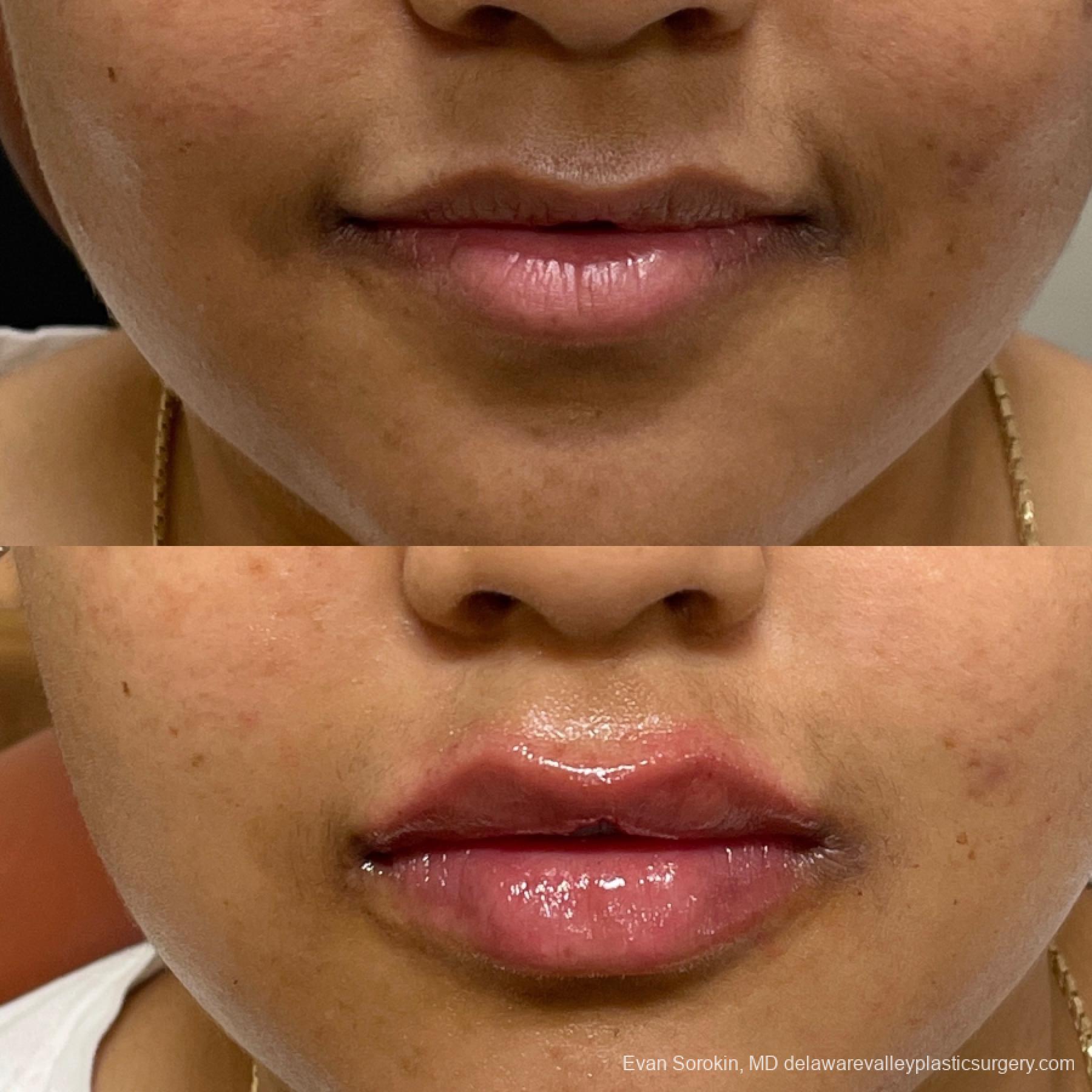 Lip Filler: Patient 10 - Before and After 