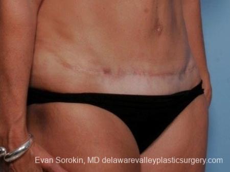Philadelphia Abdominoplasty 8682 - After Image 2