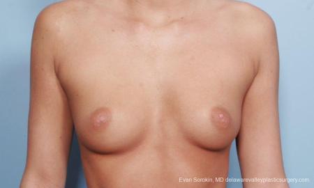 Philadelphia Breast Augmentation 9177 - Before Image 1