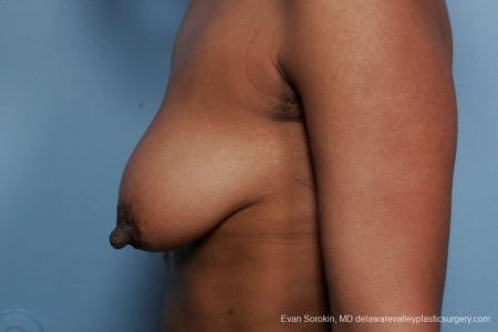 Philadelphia Breast Lift and Augmentation 8689 - Before and After Image 5