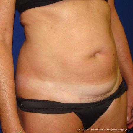 Philadelphia Liposuction 9488 - Before Image 4