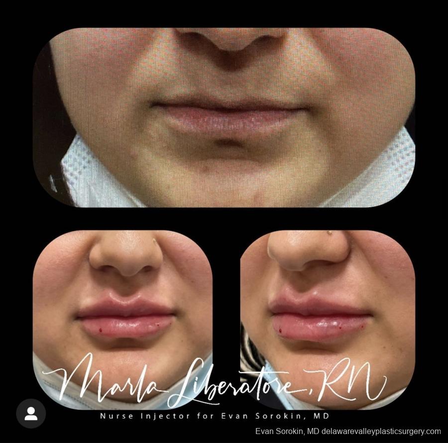 Lip Filler: Patient 8 - Before and After Image 1