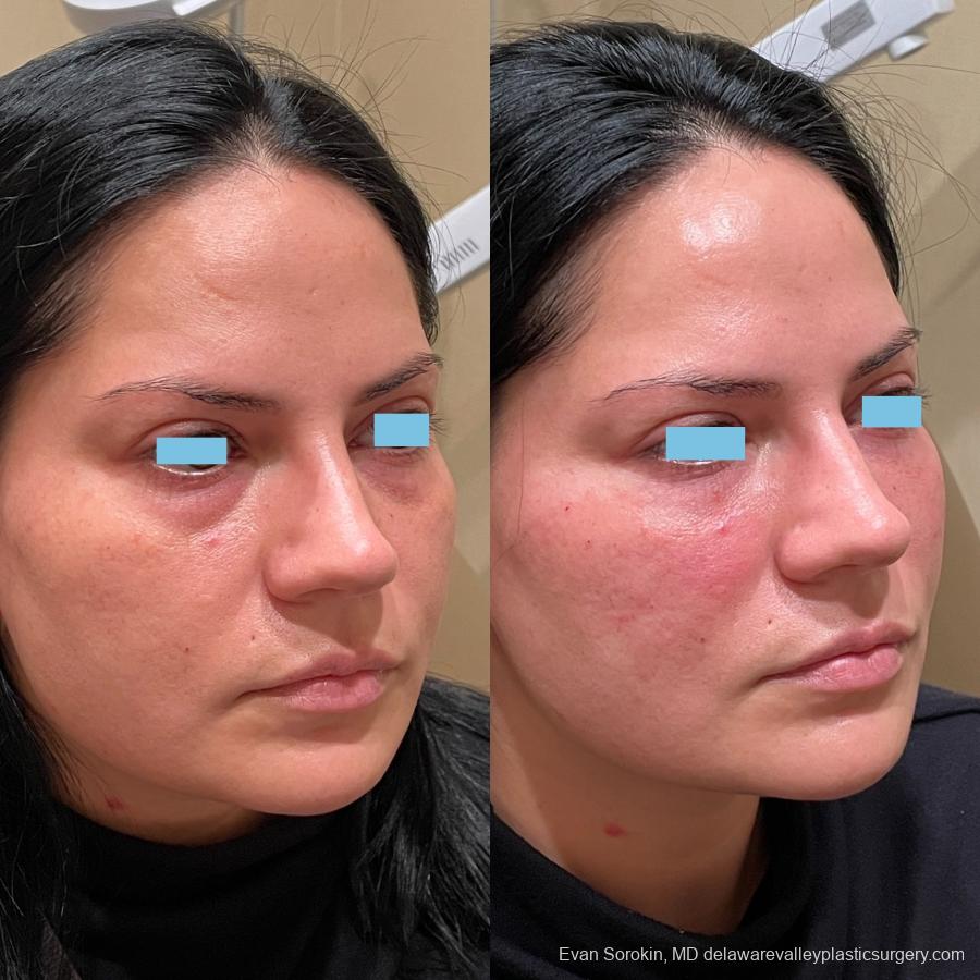 Fillers: Patient 19 - Before and After 2