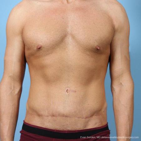 Philadelphia Abdominoplasty 9468 - After Image 1