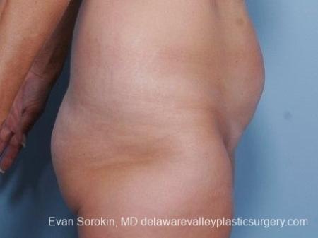 Philadelphia Abdominoplasty 8682 - Before Image 4