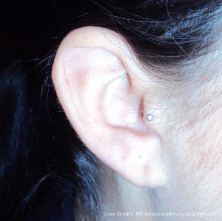 Philadelphia Earlobe Surgery 9384 - After Image 1