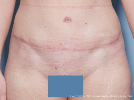 Philadelphia Abdominoplasty 9476 - After Image 1