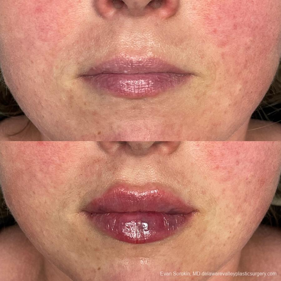 Fillers: Patient 63 - Before and After 1