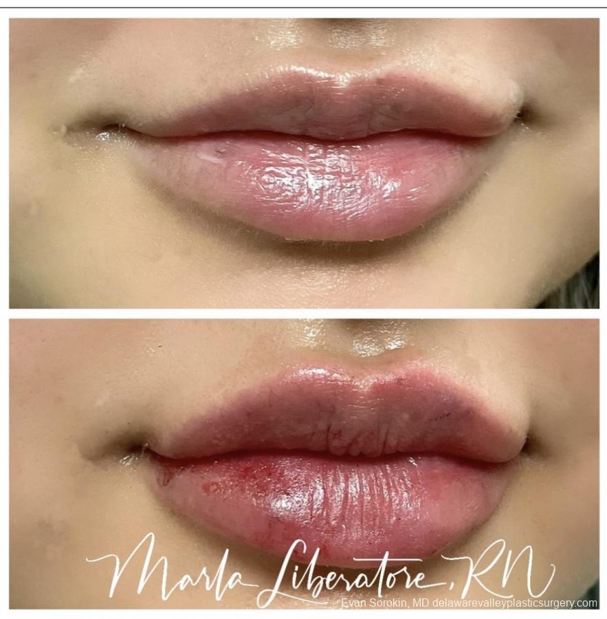 Lip Augmentation: Patient 17 - Before and After Image 1