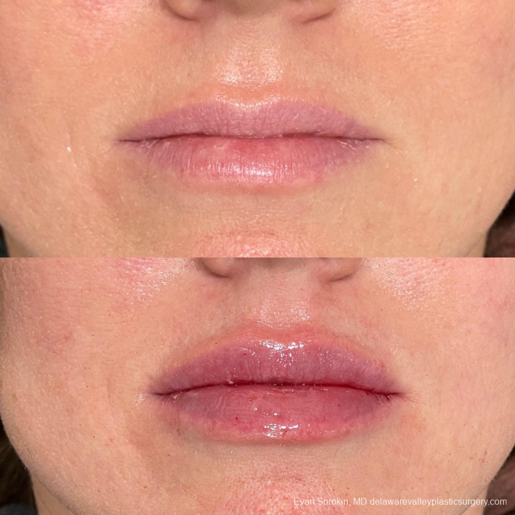 Lip Augmentation: Patient 65 - Before and After 1