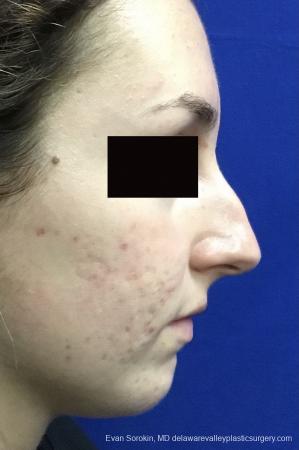 Rhinoplasty: Patient 2 - Before Image 1