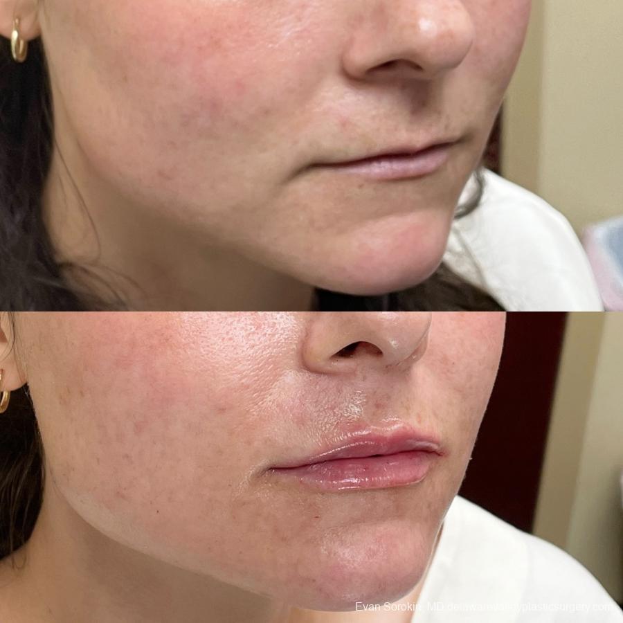 Lip Augmentation: Patient 20 - Before and After 2