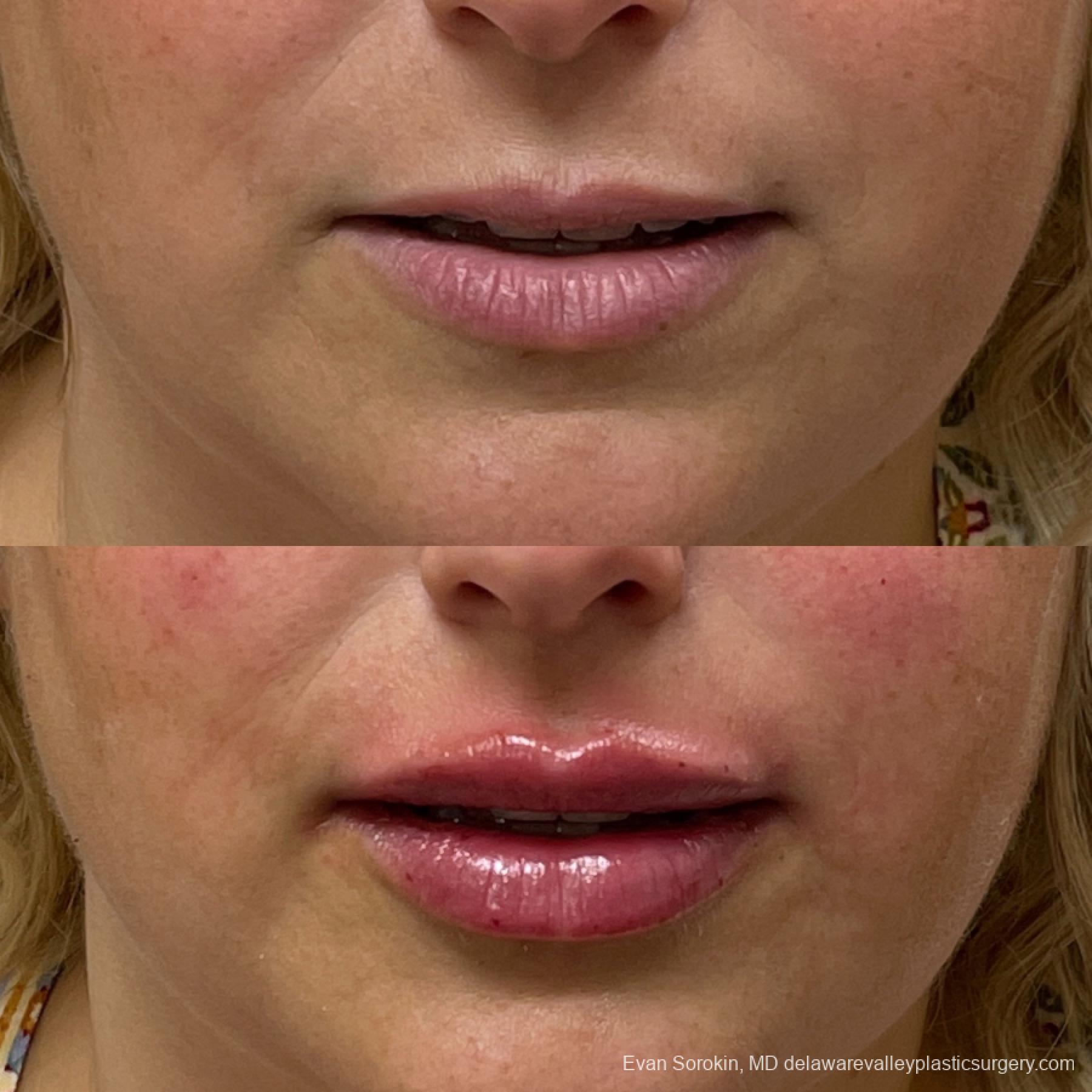 Lip Augmentation: Patient 19 - Before and After 