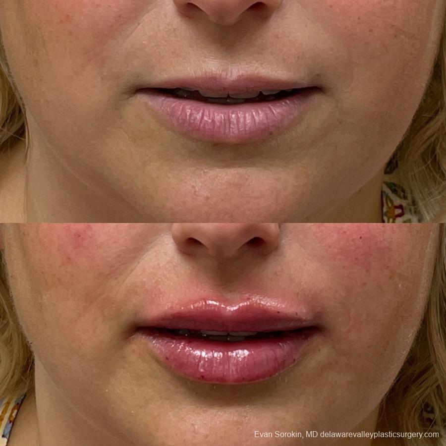 Lip Augmentation: Patient 19 - Before and After 1