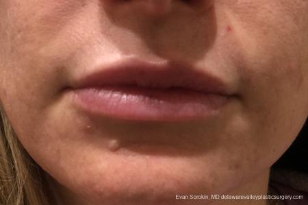 Lip Filler: Patient 12 - Before Image 1