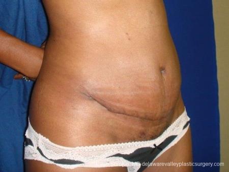 Philadelphia Abdominoplasty 8707 - After Image 3