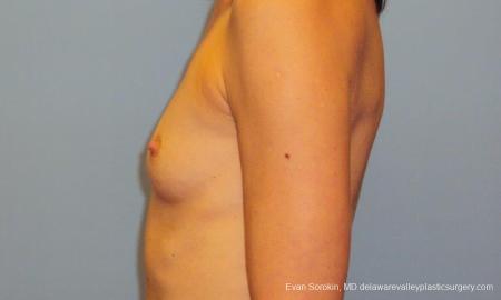 Philadelphia Breast Augmentation 9417 - Before and After Image 5
