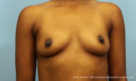Philadelphia Breast Augmentation 8768 - Before Image 1