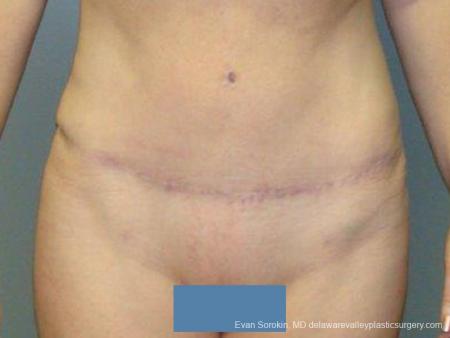 Philadelphia Abdominoplasty 9474 - After Image 1