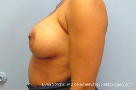 Philadelphia Breast Augmentation 9387 - After Image 5