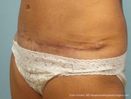 Philadelphia Abdominoplasty 9464 - After Image 4