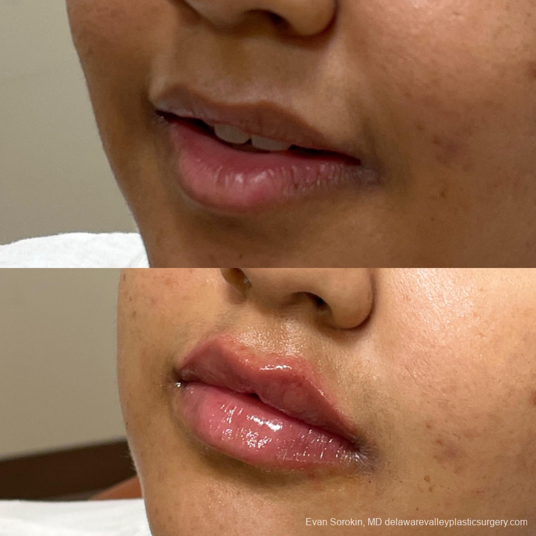 Lip Filler: Patient 10 - Before and After 3