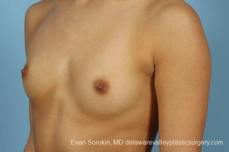 Philadelphia Breast Augmentation 9408 - Before Image 4