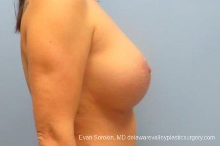 Philadelphia Breast Lift and Augmentation 8671 - After Image 4