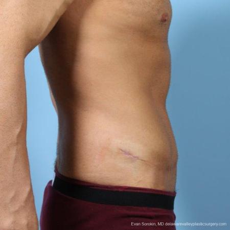 Philadelphia Abdominoplasty 9468 - After Image 3