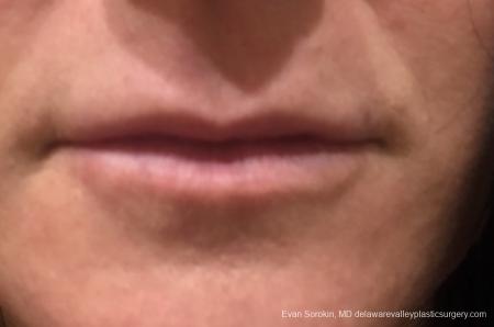 Lip Filler: Patient 13 - Before Image 1
