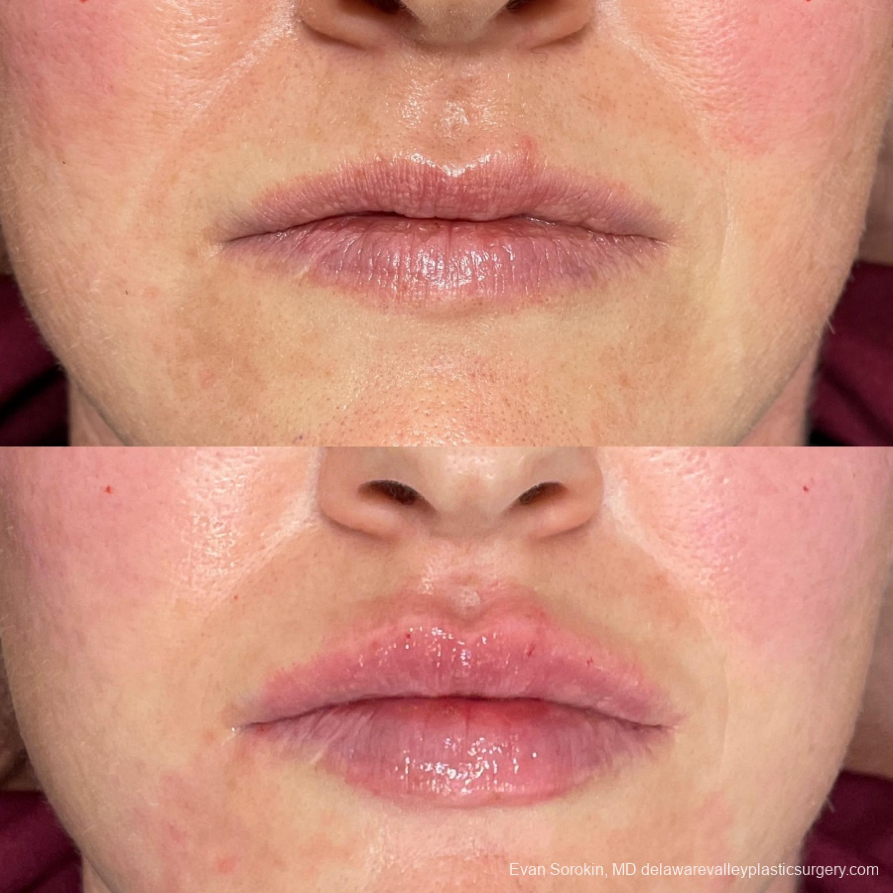 Fillers: Patient 2 - Before and After 1