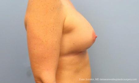 Philadelphia Breast Augmentation 9487 - After Image 3